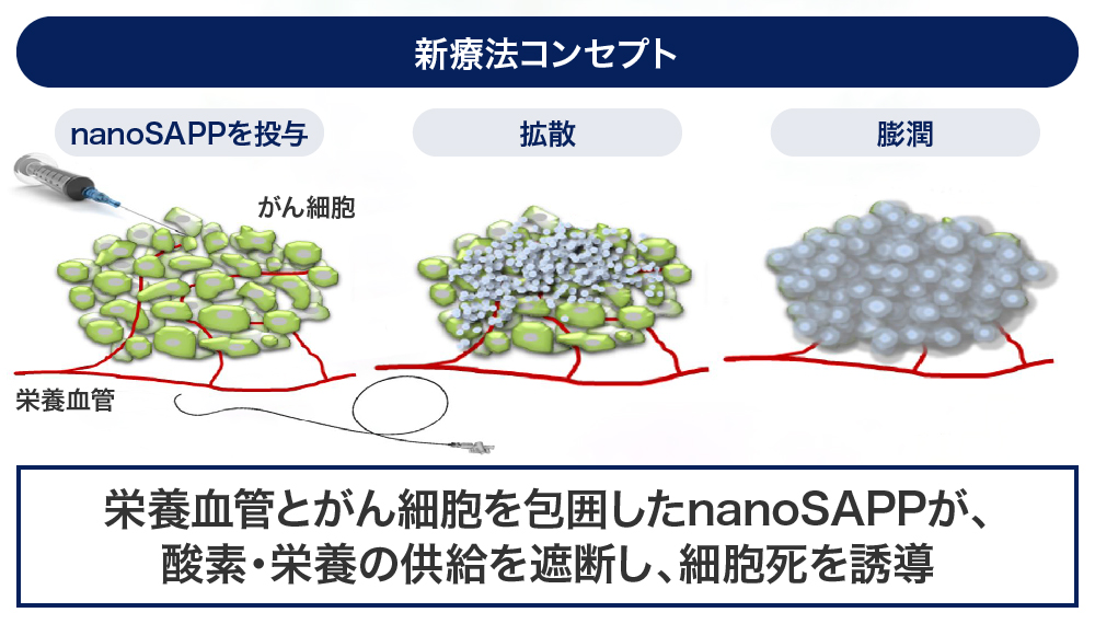 「nanoSAPP（ナノサップ）」を、カテーテルを用いて腫瘍の栄養血管に投与